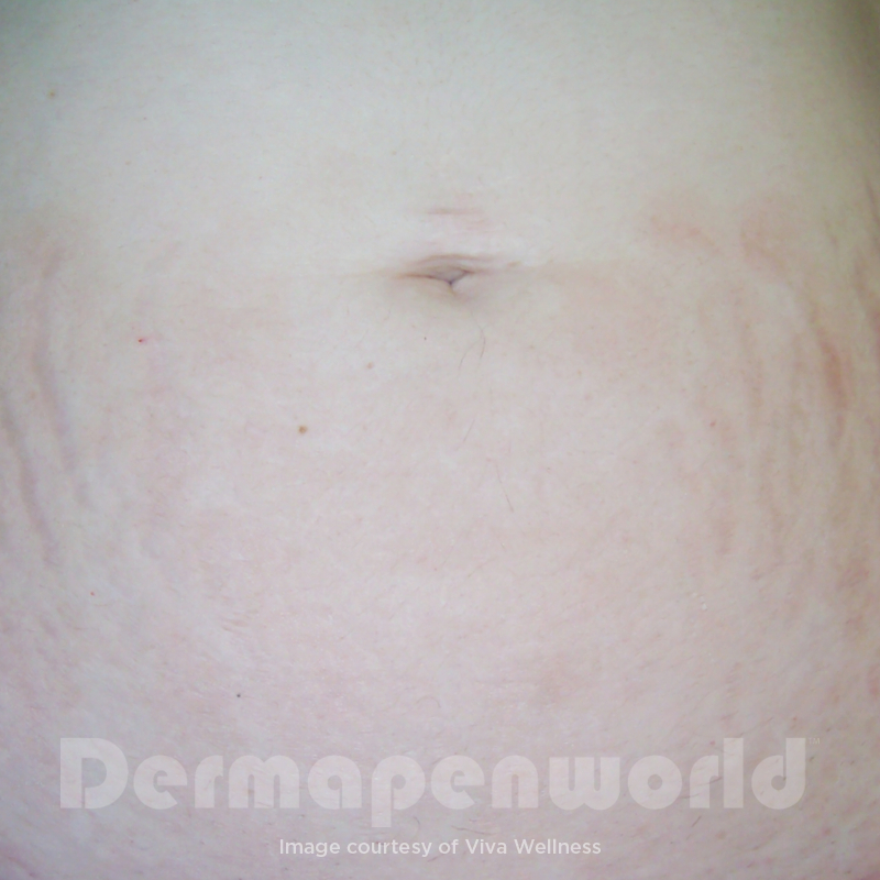 After image